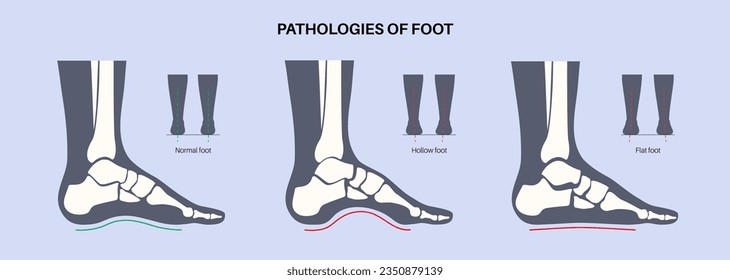 Fußpathologien anatomisches Poster. Flache, normale und hohle Füße. Ungewöhnlicher Fußbogen, Erstickung und Überpronation. Knöchelpathologie-Diagnose in der Podiatrie Klinische medizinische Vektorgrafik