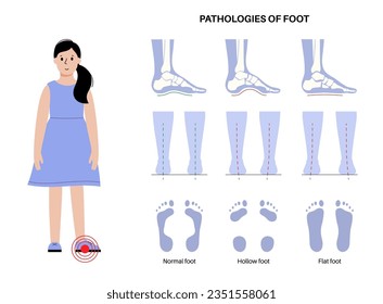 Foot pathologies anatomical poster. Flat, normal and hollow feet conditions. Abnormal feet arch, supination and overpronation. Ankle pathology diagnostic in podiatry clinic medical vector illustration