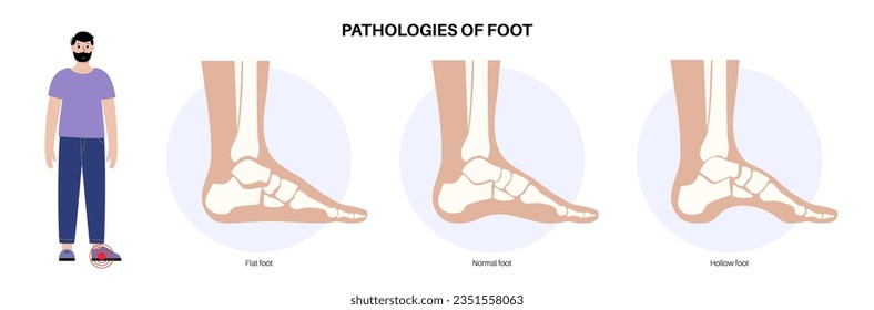 Foot pathologies anatomical poster. Flat, normal and hollow feet conditions. Abnormal feet arch, supination and overpronation. Ankle pathology diagnostic in podiatry clinic medical vector illustration