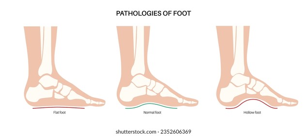 Cartel anatómico sobre patologías de pies. Condiciones de pies planas, normales y huecas. Arco anormal de los pies, supinación y sobrepronunciación. Diagnóstico de patología de la anquila en la clínica de podiatría ilustración de vectores médicos