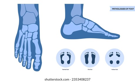 Foot pathologies anatomical poster. Flat, normal and hollow feet conditions. Abnormal feet arch, supination and overpronation. Ankle pathology diagnostic in podiatry clinic medical vector illustration