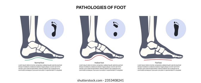 Foot pathologies anatomical poster. Flat, normal and hollow feet conditions. Abnormal feet arch, supination and overpronation. Ankle pathology diagnostic in podiatry clinic medical vector illustration