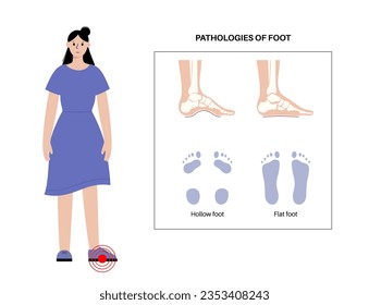 Foot pathologies anatomical poster. Flat and hollow feet conditions. Abnormal feet arch, supination and overpronation deformation. Ankle pathology diagnostic in podiatry clinic vector illustration