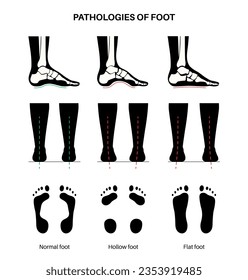 Foot pathologies anatomical poster. Flat, normal and hollow feet conditions. Abnormal feet arch, supination and overpronation. Ankle pathology diagnostic in podiatry clinic medical vector illustration