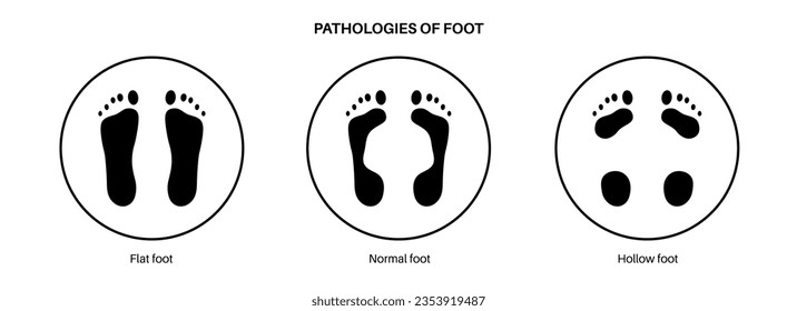 Foot pathologies anatomical poster. Flat, normal and hollow feet conditions. Abnormal feet arch, supination and overpronation. Ankle pathology diagnostic in podiatry clinic medical vector illustration