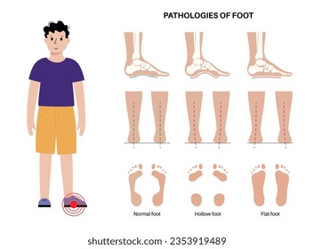 Foot pathologies anatomical poster. Flat, normal and hollow feet conditions. Abnormal feet arch, supination and overpronation. Ankle pathology diagnostic in podiatry clinic medical vector illustration