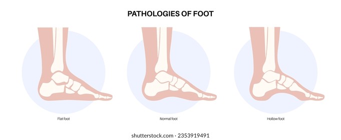 Foot pathologies anatomical poster. Flat, normal and hollow feet conditions. Abnormal feet arch, supination and overpronation. Ankle pathology diagnostic in podiatry clinic medical vector illustration