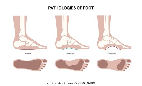 Foot pathologies anatomical poster. Flat, normal and hollow feet conditions. Abnormal feet arch, supination and overpronation. Ankle pathology diagnostic in podiatry clinic medical vector illustration