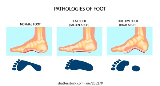 types of flat feet