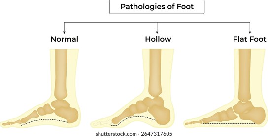 Patologias do pé comparação anatômica normal do pé oco e plano Design de Ilustração Médica