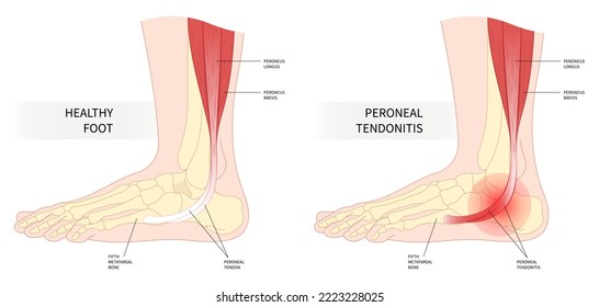 foot peroneal tendonitis painful ankle torn tendon swollen trauma side sport fall injury fifth metatarsal flat feet heel motion calf gout high arches weakness stress leg bone