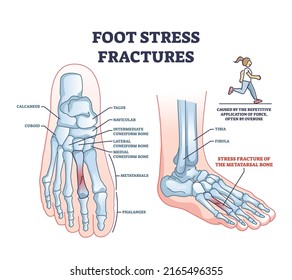 Foot stress fractures as bone cracking trauma or injury outline diagram. Labeled educational scheme with leg skeletal anatomy and orthopedic problem caused by repetitive overuse vector illustration.