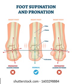 Foot supination and pronation vector illustration. Labeled medical scheme with incorrect leg joint movement. Educational diagram with pronated, normal and supinated compared examples with bone titles.