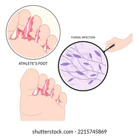 foot toe Itchiness with and jock itch symptom smell bad of Athlete's pus fungus bacteria