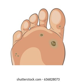 Foot wart. Foot bottom pathology: verruca, wart, papilloma virus. Many small warts on the sole and toe. Male or female sole, barefoot. Cartoon style, hand drawn. Vector illustration isolated on white.