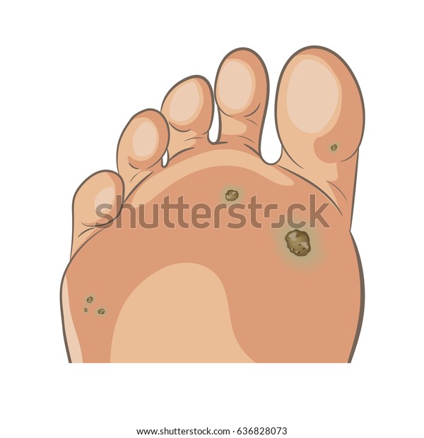 フット ワート 足下病理 いぼ いぼ パピローマウイルス 足の裏と足の指に小さなワートがたくさんある 男性または女性の足裏 裸足 手描きのカートーンスタイル 白い背景にベクターイラスト のベクター画像素材 ロイヤリティフリー