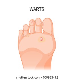 Foot wart. Many warts on the bottom of soles and toes.