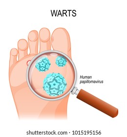 Foot Warts are caused by infection with a type of human papillomavirus. Close-up of HPV