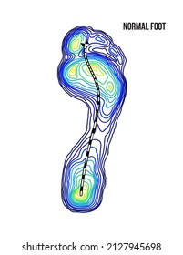 Foot weight distribution. Normal arch foot bottom thermal view. No deformation.