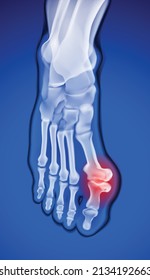 Foot x-rays of the very painful thumb joint deformity used in medicine and education.