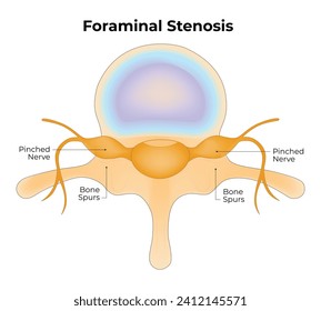Foraminal Stenosis Science Design Vector Illustration