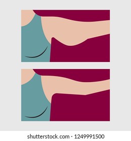 Forearm liposuction, plastic surgery arm lift, arm lift exercises, weight loss. Vector illustration