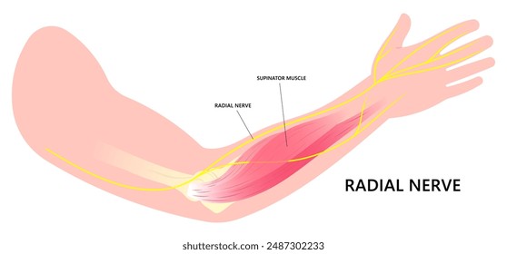 Forearm nerve compressed of Tinel's and Golfer's elbow syndrome