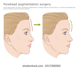 Cirurgia de aumento da testa antes e depois da ilustração do vetor. Ilustração médica de cirurgia estética plástica.