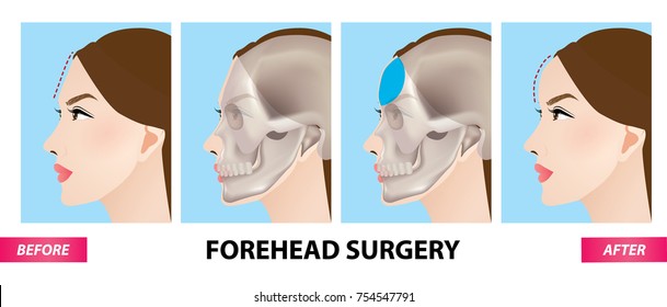 Forehead plastic surgery before and after vector illustration