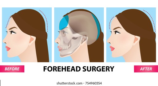 Forehead plastic surgery before and after vector illustration