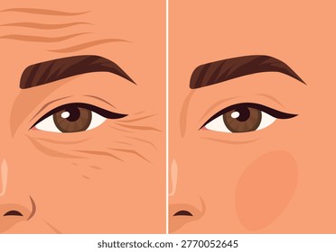 Forehead wrinkles. Vector illustration of before and after skincare treatments smoothing facial wrinkles. Suitable for anti-aging, cosmetic, and surgical treatments