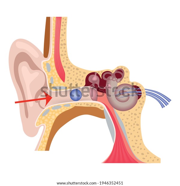 Foreign body in the\
inner ear. The structure of the human auditory system. Medical\
poster. Vector\
illustration