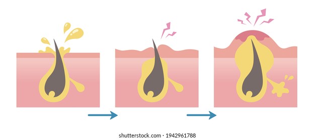 Formation of acne process. Oily pore, clogged with sebum, and pustules. Pale colored illustration in flat cartoon style.