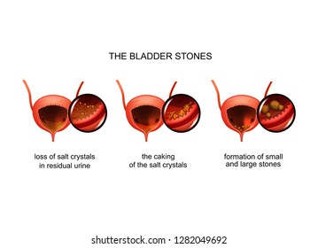 formation of bladder stones