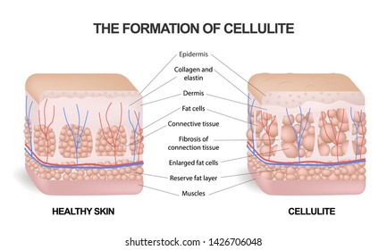 The formation of cellulite. Cellulite occurs in most females and rarely in males. Vector diagram. Comparative illustration of normal skin and cellulite s skin.