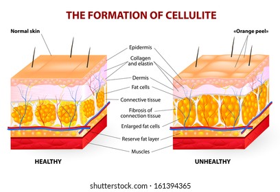 The formation of cellulite.  Cellulite occurs in most females and rarely in males. Vector diagram.