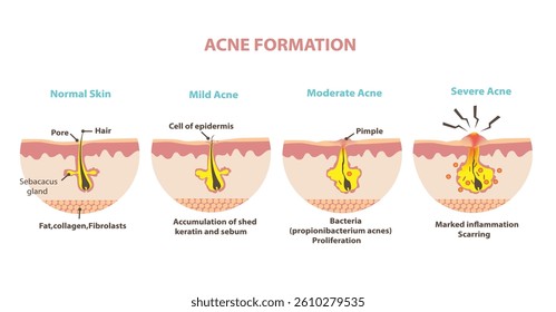 Formation of skin acne or pimple