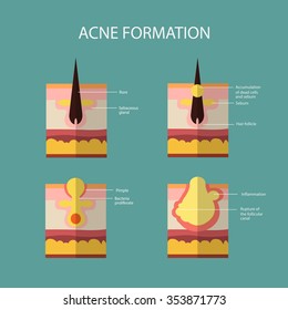 Formation of skin acne or pimple. 