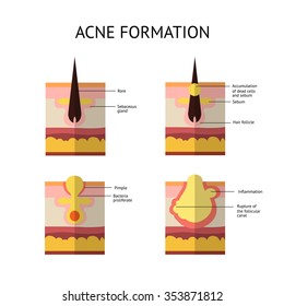 Formation of skin acne or pimple. 