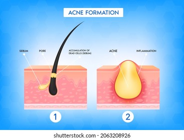 Formation of skin acne or pimple. Accumulation of dead cells and inflammation associated with pimples.The sebum in the clogged pore promotes the growth of a certain bacteria. 3D vector illustration.