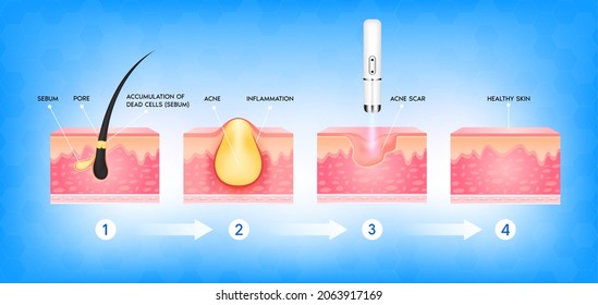 Formation of skin acne or pimple. Accumulation of dead cells the sebum in the clogged pore promotes growth of bacteria. Acne scar vascular laser treatment. Medical beauty skin care concept. 3D vector.