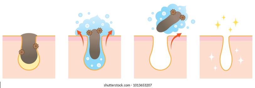 formando limpador suavemente desentupir poros. antes e depois do tratamento de cuidados com a pele