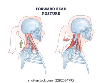 Forward head posture compared with healthy neck position outline diagram. Educational scheme with turtle neck condition and muscular system vector illustration. Anatomical spine problem explanation. - Shutterstock ID 2282034795