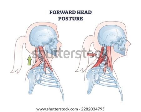 Forward head posture compared with healthy neck position outline diagram. Educational scheme with turtle neck condition and muscular system vector illustration. Anatomical spine problem explanation.