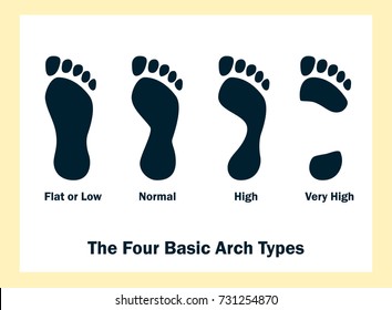 The Four Basic Arch Types. Set of flat foot, high arch