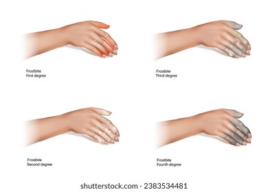 Las cuatro etapas de la congelación. Lesiones cutáneas que ocurren cuando se exponen a temperaturas extremas bajas, causando la congelación de la piel u otros tejidos.