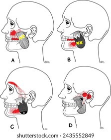 Four masetero trigger points Diagram