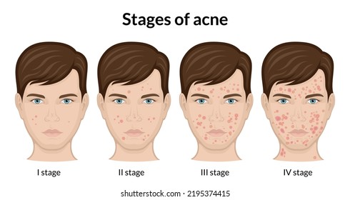 Four Stages Of Acne On The Face Of A Young Man