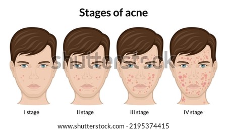 Four stages of acne on the face of a young man