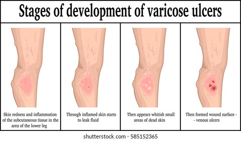Four stages of development of varicose ulcers on the lower leg